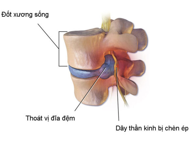 Hiện tượng thoát vị đĩa đệm có gây biến chứng nguy hiểm không?