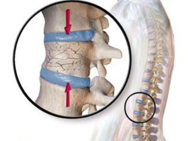 Thoái hóa đốt sống căn bệnh quái ác bắt nguồn do lối sống không khoa học 