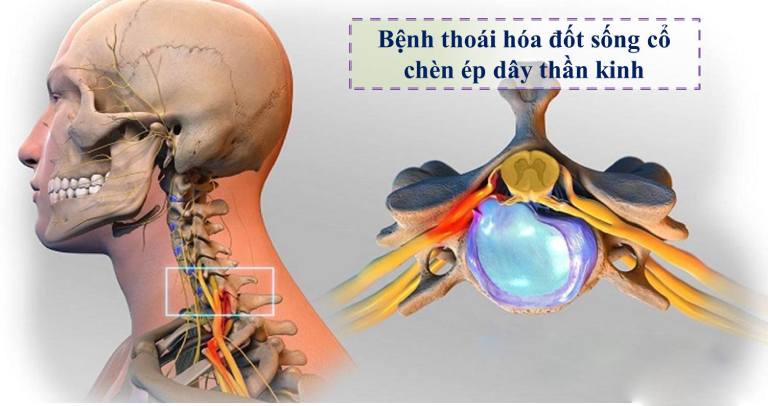 Bật mí nguyên nhân thoái hoá đốt sống cổ và giải pháp chưa trị tận gốc