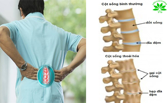 Nguyên nhân bị thoái hóa đốt sống lưng